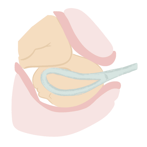 Comment fonctionne l'accouchement par forceps ? may app santé 