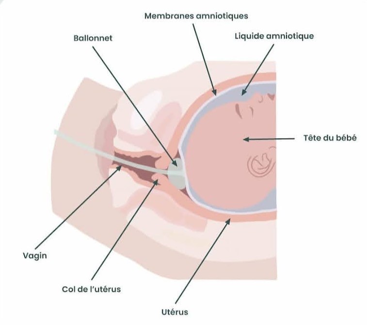 ballonnet accouchement