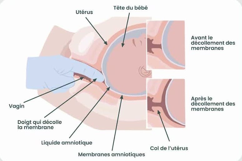 ballonnet accouchement