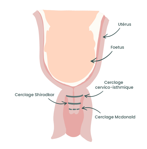Cerclage du col de l'utérus : pour qui, quand et comment ? May app santé